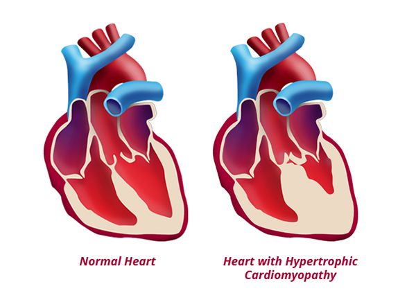 MyoKardia