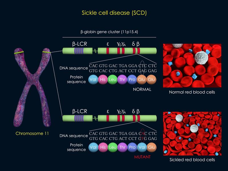 Sickle Cell Disease