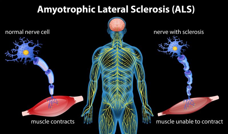 amyotrophic lateral sclerosis (ALS)