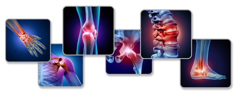 Rheumatoid Arthritis