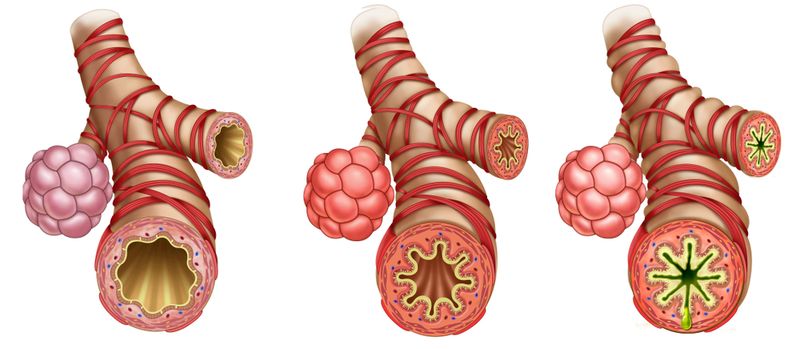 severe asthma