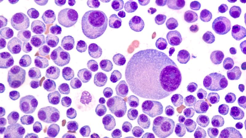 Multiple Myeloma