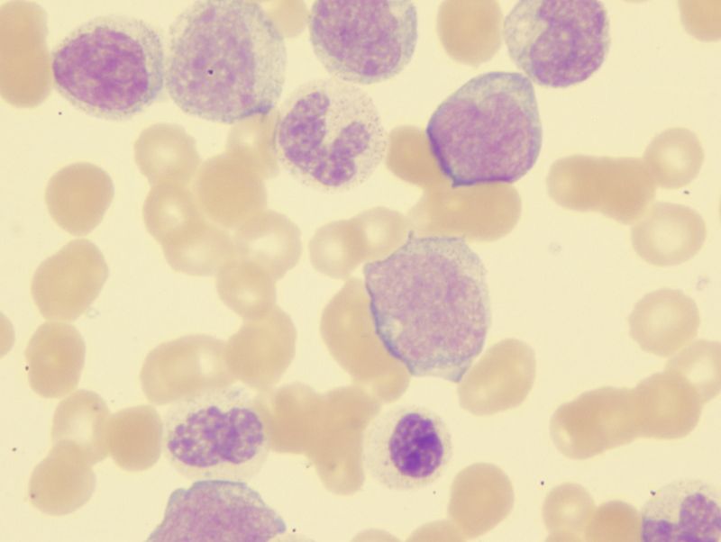 chronic myelomonocytic leukemia (CMML)