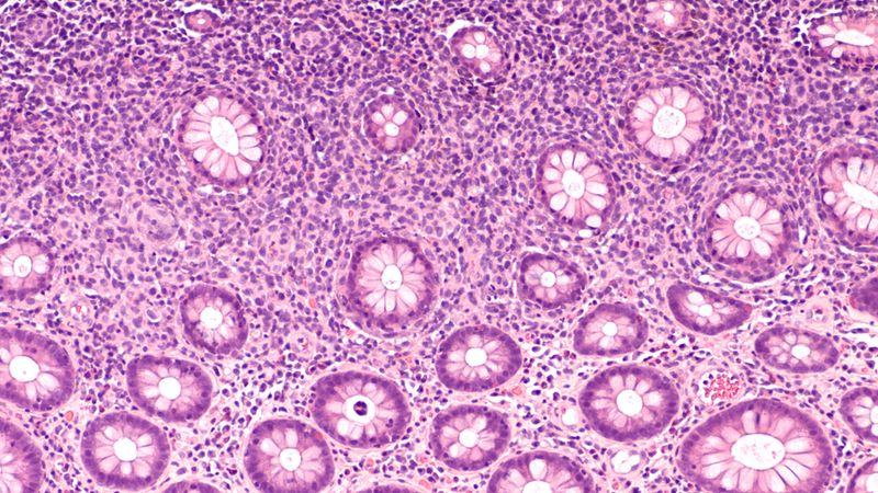 Large B-Cell Lymphoma