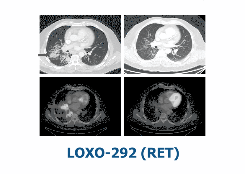 Selpercatinib (LOXO-292)
