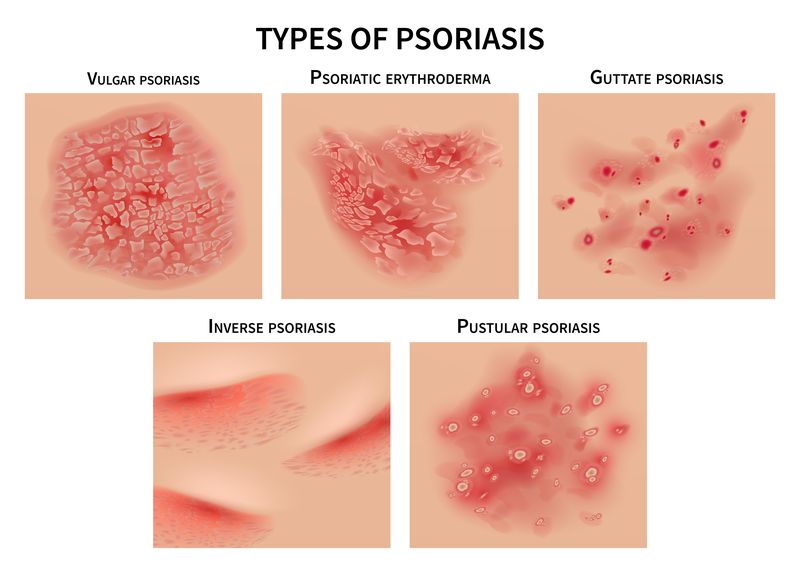 Psoriasis