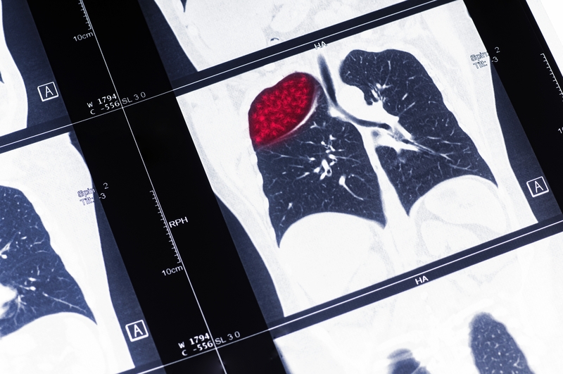 Non-Small Cell Lung Cancer