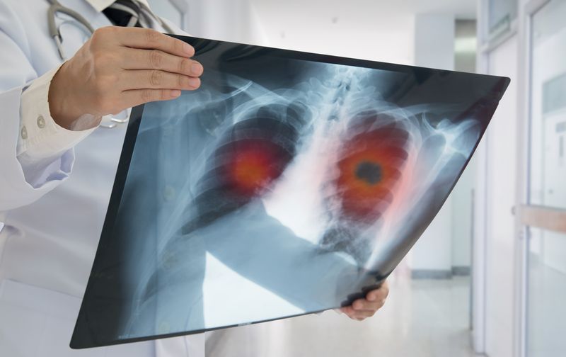 Non-Small Cell Lung Cancer