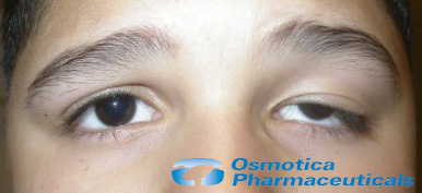 Upneeq (oxymetazoline hydrochloride ophthalmic solution)