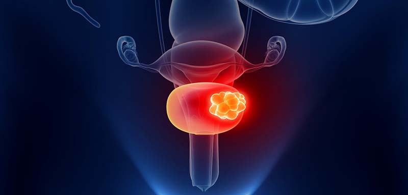 bladder cancer