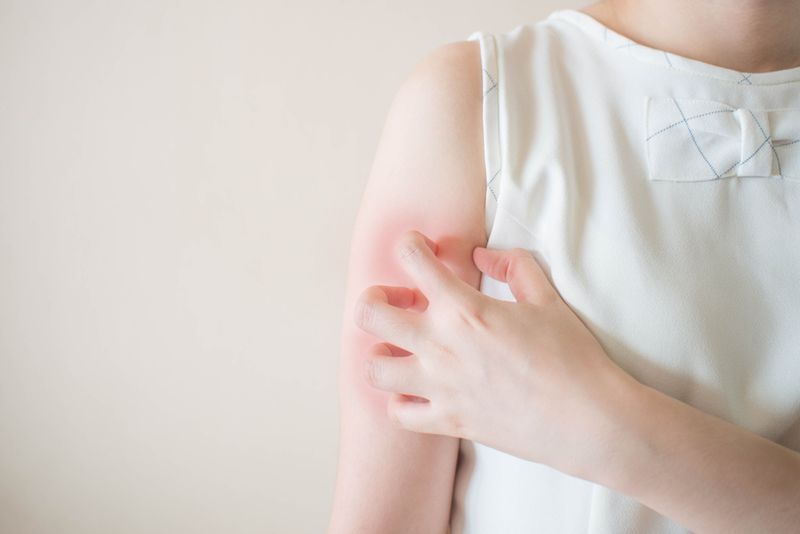 Chronic Idiopathic Urticaria (CIU)