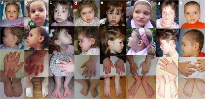 CDKL5 Deficiency Disorder (CDD)