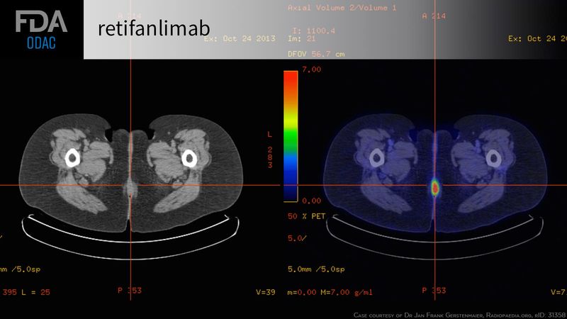 Retifanlimab for the Treatment of Certain Patients with Squamous Cell Carcinoma of the Anal Canal (SCAC)