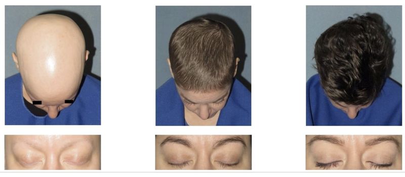 Alopecia Areata