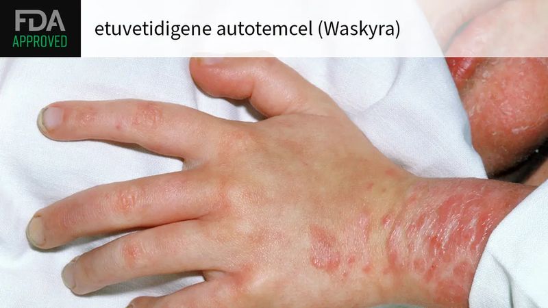 Waskyra (etuvetidigene autotemcel) Waskyra (etuvetidigene autotemcel)